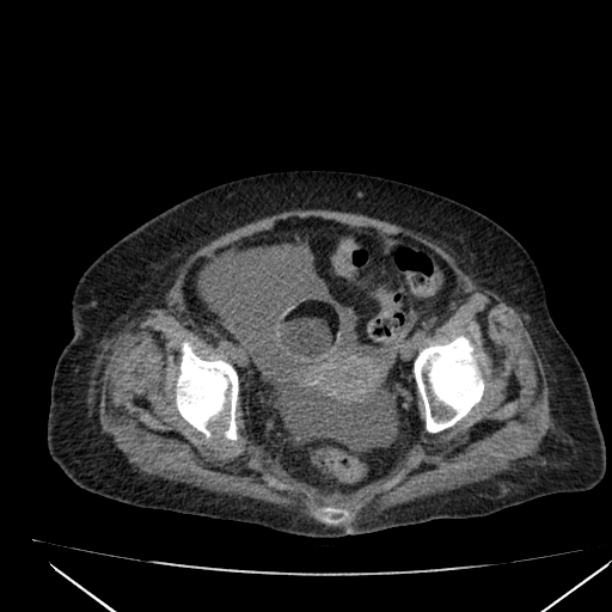 Acute tubular necrosis (Radiopaedia 28077-28334 Axial non-contrast 61).jpg
