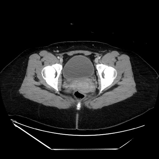 Acute uncomplicated appendicitis (Radiopaedia 73704-84499 Axial C+ portal venous phase 153).jpg