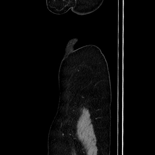 Acute uncomplicated appendicitis (Radiopaedia 73704-84499 Sagittal C+ portal venous phase 33).jpg