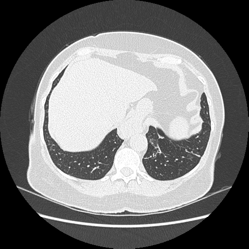 Adenocarcinoma in situ of lung (Radiopaedia 38685-40829 B 188).png