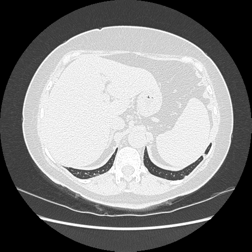 Adenocarcinoma in situ of lung (Radiopaedia 38685-40829 B 207).png