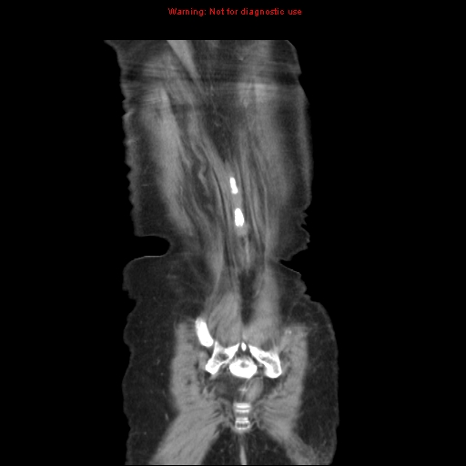File:Adenocarcinoma of the colon (Radiopaedia 8191-9039 Coronal liver window 44).jpg