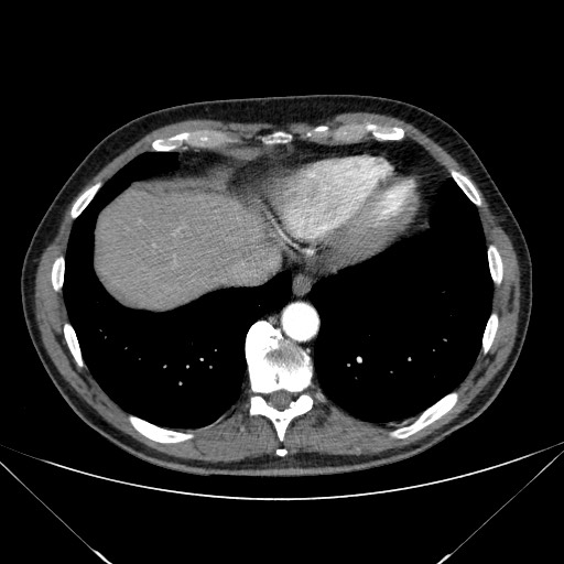 File:Adenocarcinoma of the lung (Radiopaedia 59871-67325 Axial C+ arterial phase 75).jpg
