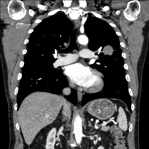 Adenocarcinoma of the lung (Radiopaedia 59871-67325 Coronal C+ arterial phase 37).jpg