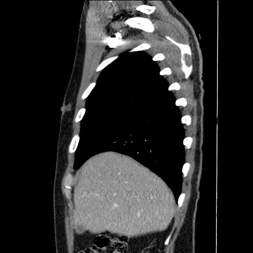 File:Adenocarcinoma of the lung (Radiopaedia 59871-67325 Sagittal C+ arterial phase 15).jpg