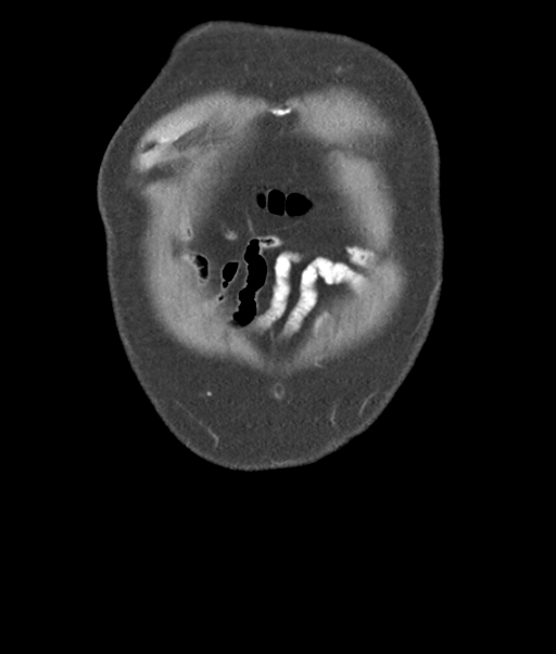 Adenocarcioma of rectum- T1 lesion (Radiopaedia 36921-38547 Coronal C+ portal venous phase 5).png
