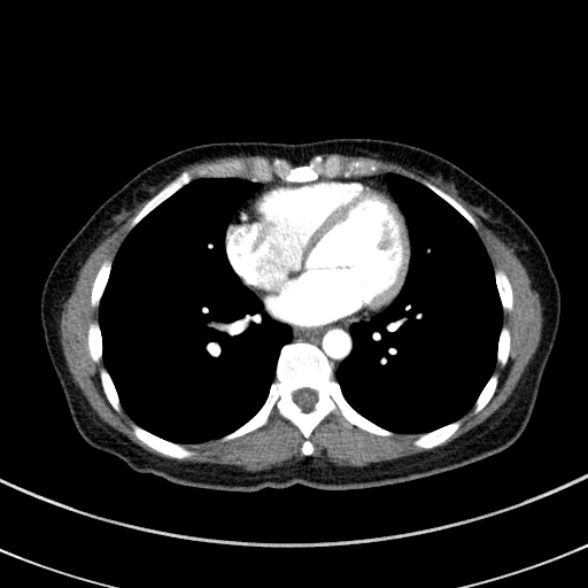 Adenocystic carcinoma of the trachea (Radiopaedia 47677-52525 Axial C+ arterial phase 60).jpg