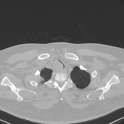 Adenoid cystic carcinoma of the trachea (Radiopaedia 49042-54137 Axial lung window 31).jpg