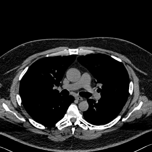Adenoid cystic carcinoma of the trachea (Radiopaedia 49042-54137 Axial non-contrast 146).jpg