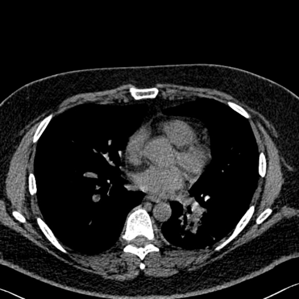 File:Adenoid cystic carcinoma of the trachea (Radiopaedia 49042-54137 Axial non-contrast 198).jpg