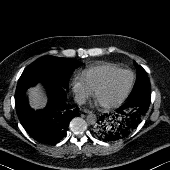 Adenoid cystic carcinoma of the trachea (Radiopaedia 49042-54137 Axial non-contrast 245).jpg