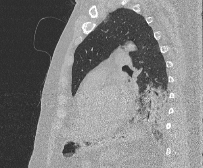 Adenoid cystic carcinoma of the trachea (Radiopaedia 49042-54137 Sagittal lung window 298).jpg