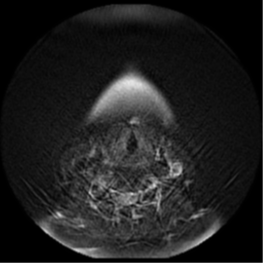 File:Adenoid cystic tumor of palate (Radiopaedia 46980-51519 Axial T2 6).png