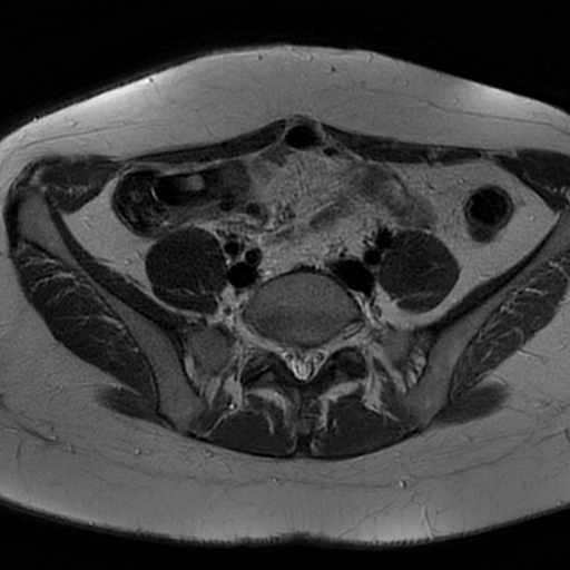 File:Adenomyosis-scar endometriosis (Radiopaedia 65863-75022 Axial T2 1).jpg