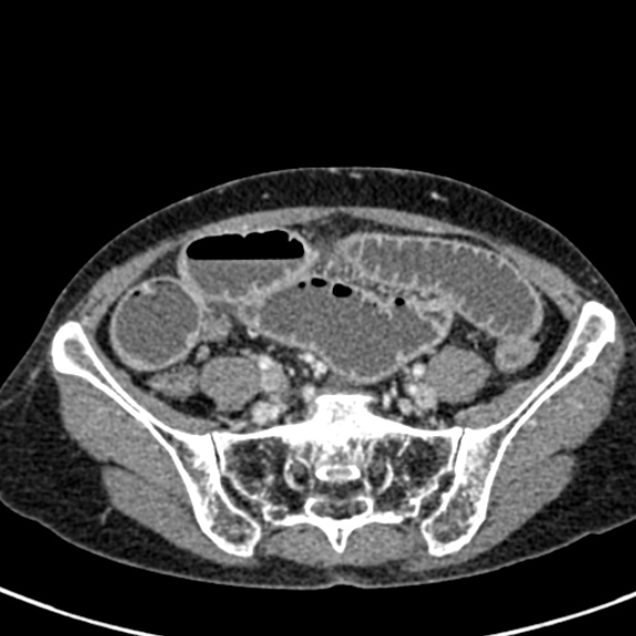 Adhesional small bowel obstruction (Radiopaedia 48397-53305 Axial C+ portal venous phase 66).jpg