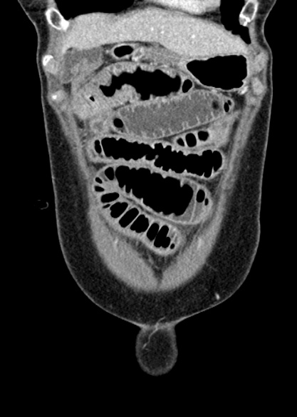 Adhesional small bowel obstruction (Radiopaedia 48397-53305 Coronal C+ portal venous phase 62).jpg