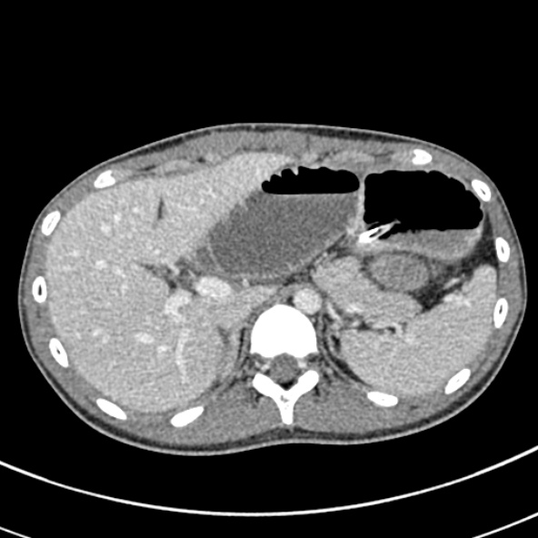 Adhesional small bowel obstruction (Radiopaedia 52107-57980 Axial C+ portal venous phase 24).jpg