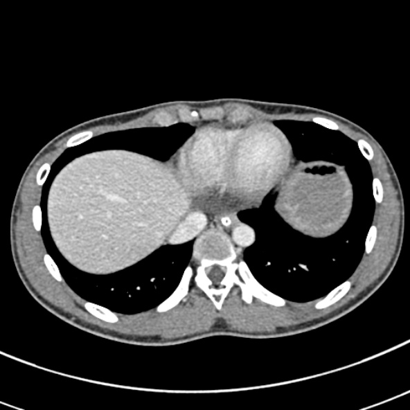 File:Adhesional small bowel obstruction (Radiopaedia 52107-57980 Axial C+ portal venous phase 8).jpg