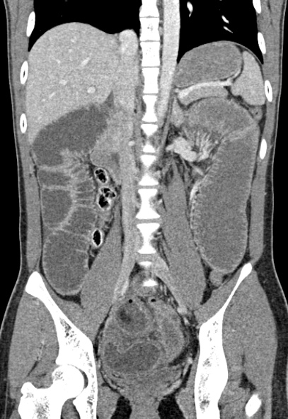 File:Adhesional small bowel obstruction (Radiopaedia 52107-57980 Coronal C+ portal venous phase 47).jpg