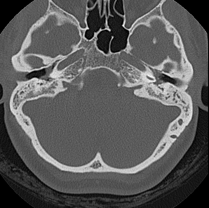File:Adhesive chronic otitis media (Radiopaedia 14270-14148 Axial bone window 10).jpg