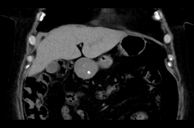 Adrenal cortical carcinoma (Radiopaedia 64017-72769 Coronal non-contrast 17).jpg