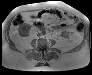 File:Adrenal cortical carcinoma (Radiopaedia 64017-72770 Axial T1 in-phase 57).jpg