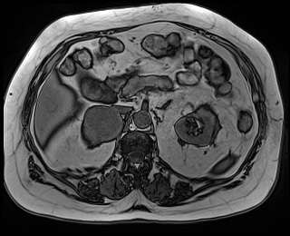 File:Adrenal cortical carcinoma (Radiopaedia 64017-72770 Axial T1 out-of-phase 32).jpg