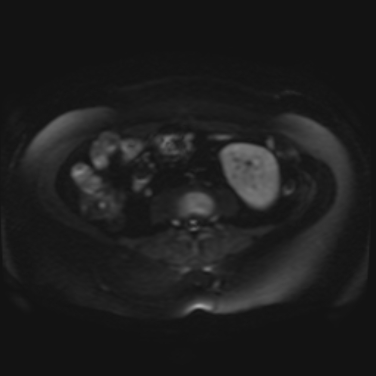 Adrenal cortical carcinoma (Radiopaedia 70906-81116 Axial DWI 24).jpg
