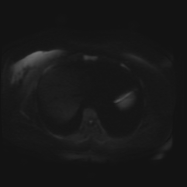 Adrenal cortical carcinoma (Radiopaedia 70906-81116 Axial DWI 31).jpg