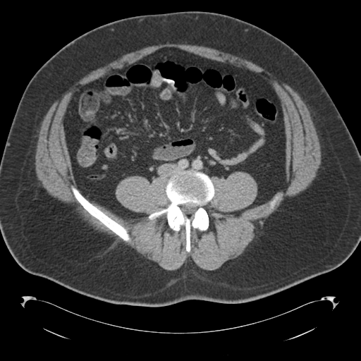 File:Adrenal cyst (Radiopaedia 45625-49776 Axial C+ portal venous phase 61).png