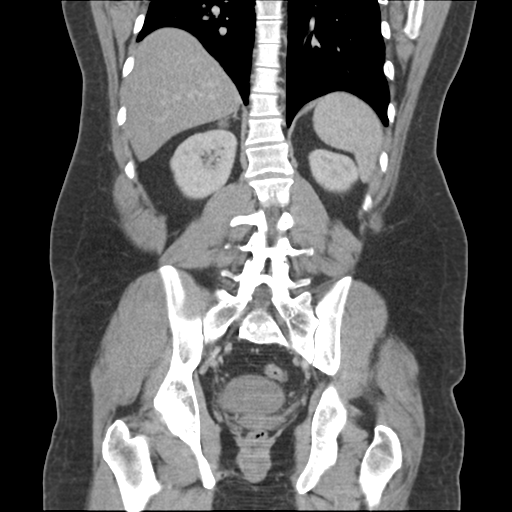 Adrenal cyst (Radiopaedia 45625-49776 Coronal C+ portal venous phase 51).png