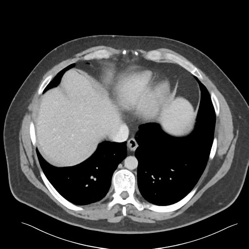 File:Adrenal cyst (Radiopaedia 45625-49777 Axial C+ portal venous phase 15).png