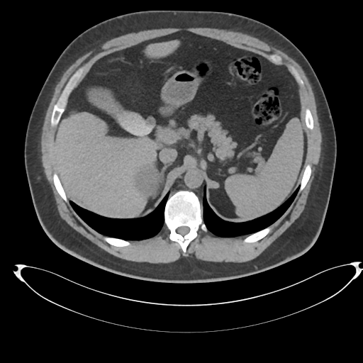 Adrenal cyst (Radiopaedia 45625-49778 Axial non-contrast 26).png