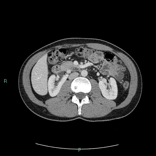 Adrenal cystic lymphangioma (Radiopaedia 83161-97534 Axial C+ portal venous phase 43).jpg