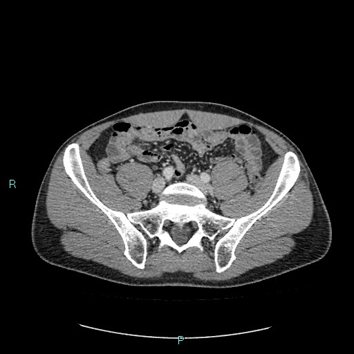 Adrenal cystic lymphangioma (Radiopaedia 83161-97534 Axial C+ portal venous phase 71).jpg