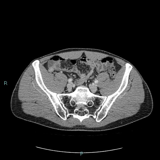 Adrenal cystic lymphangioma (Radiopaedia 83161-97534 Axial C+ portal venous phase 75).jpg
