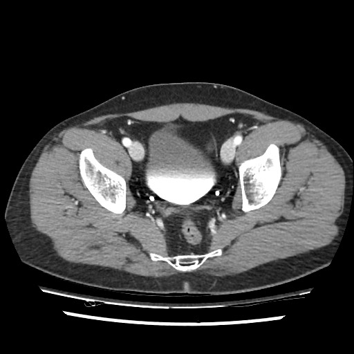 File:Adrenal gland trauma (Radiopaedia 81351-95078 Axial Dual bolus trauma C+ 111).jpg