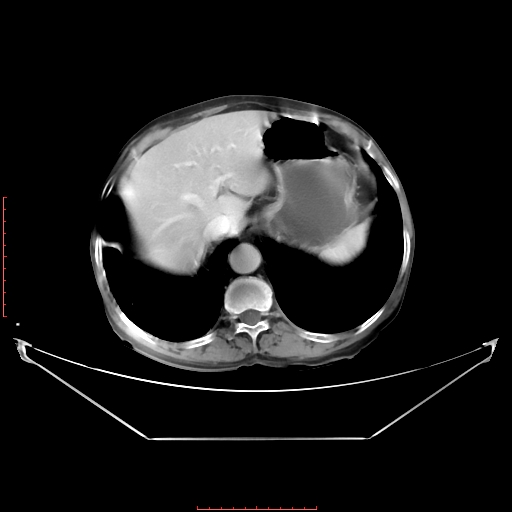 Adrenal hemangioma (Radiopaedia 68923-78668 Axial C+ portal venous phase 19).jpg