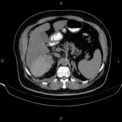 Adrenal hemorrhage (Radiopaedia 62622-70916 Axial non-contrast 57).jpg