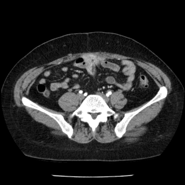 Adrenal myelolipoma (Radiopaedia 43401-46759 Axial C+ arterial phase 73).jpg