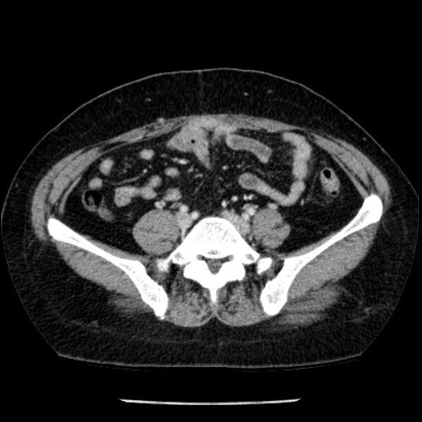 File:Adrenal myelolipoma (Radiopaedia 43401-46759 Axial C+ portal venous phase 60).jpg