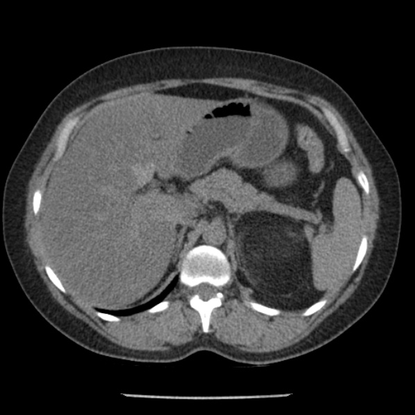 Adrenal myelolipoma (Radiopaedia 43401-46759 Axial non-contrast 24).jpg