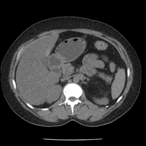 File:Adrenal myelolipoma (Radiopaedia 43401-46759 Axial non-contrast 30).jpg
