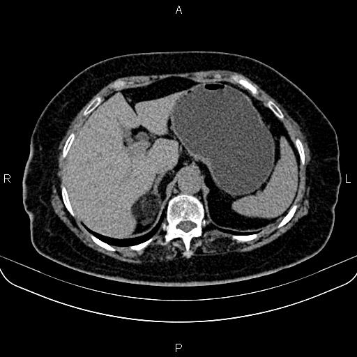 Adrenal myelolipoma (Radiopaedia 82742-96986 Axial non-contrast 33).jpg
