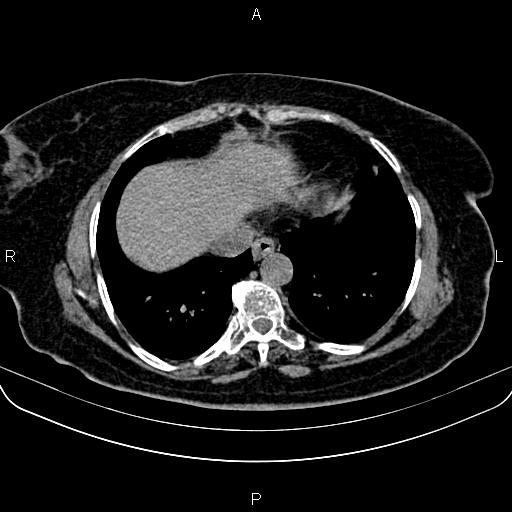 Adrenal myelolipoma (Radiopaedia 82742-96986 Axial non-contrast 6).jpg