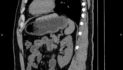 File:Adrenal myelolipoma (Radiopaedia 84321-99619 Sagittal non-contrast 76).jpg