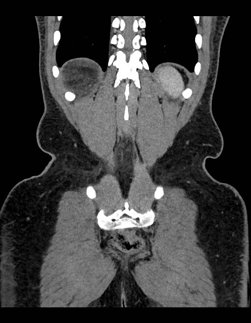 Adrenal myelolipoma - bilateral (Radiopaedia 74805-85810 Coronal C+ portal venous phase 70).jpg