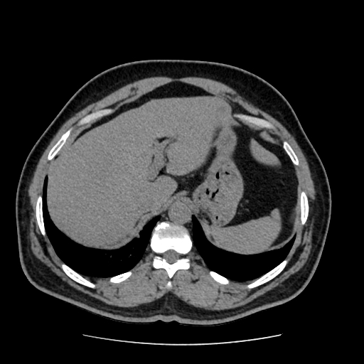 Adrenal myelolipoma and beaver tail liver (Radiopaedia 86201-102193 Axial non-contrast 84).jpg