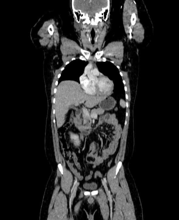 Adrenocortical carcinoma (Radiopaedia 80134-93438 Coronal C+ portal venous phase 65).jpg