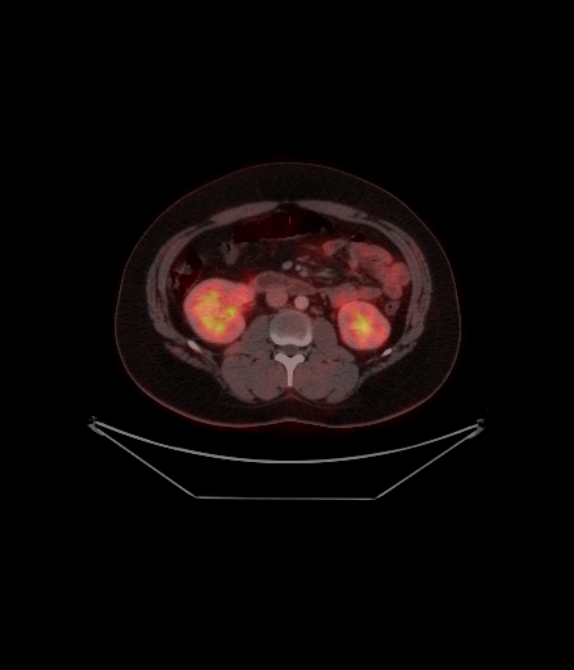 Adrenocortical carcinoma (Radiopaedia 80134-93440 ِAxial 184).jpg